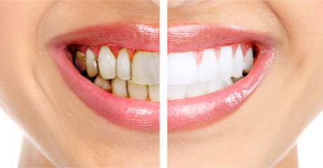 Before Whitening Your Teeth!