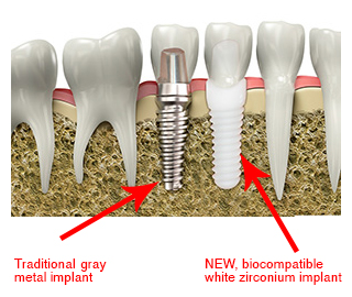 Ceramic Implants At Oakville North Dentistry