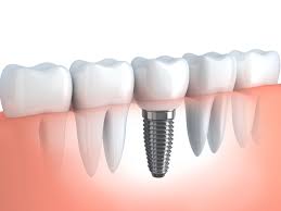Is It Painful To Get Dental Implants?
